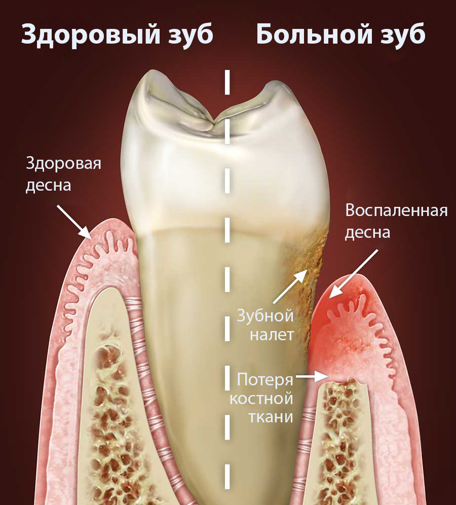 Periodontics illustration rus